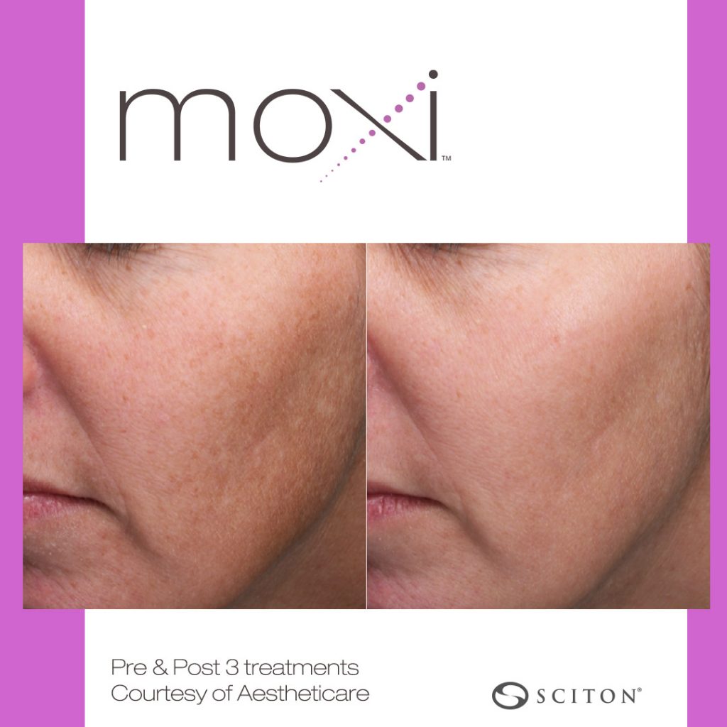 Before and after MOXI laser skin rejuventation